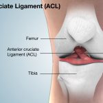 آسیب لیگامان ACL