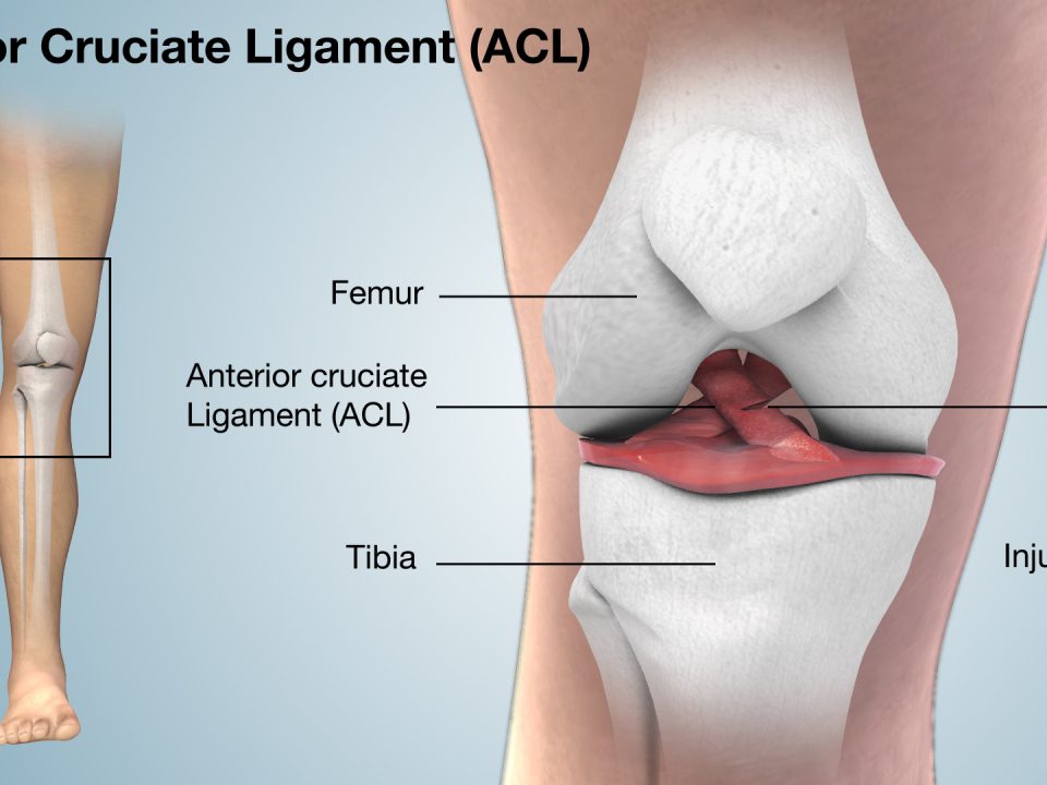 آسیب لیگامان ACL