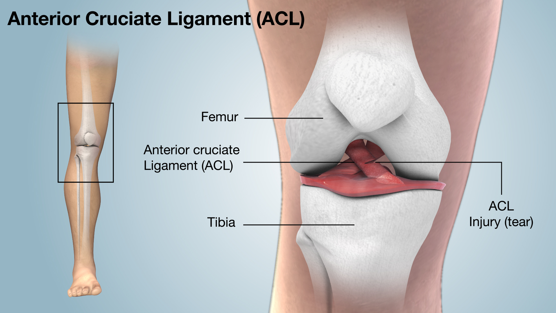 آسیب لیگامان ACL